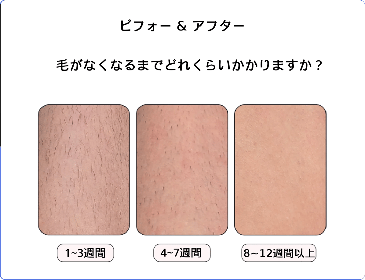 before and after ipl hair removal (1)